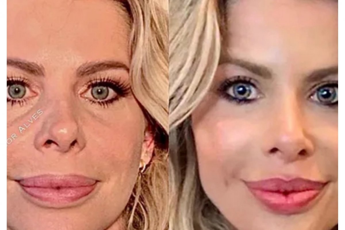 Médico mostra antes e depois de preenchimento labial de Karina Bacchi