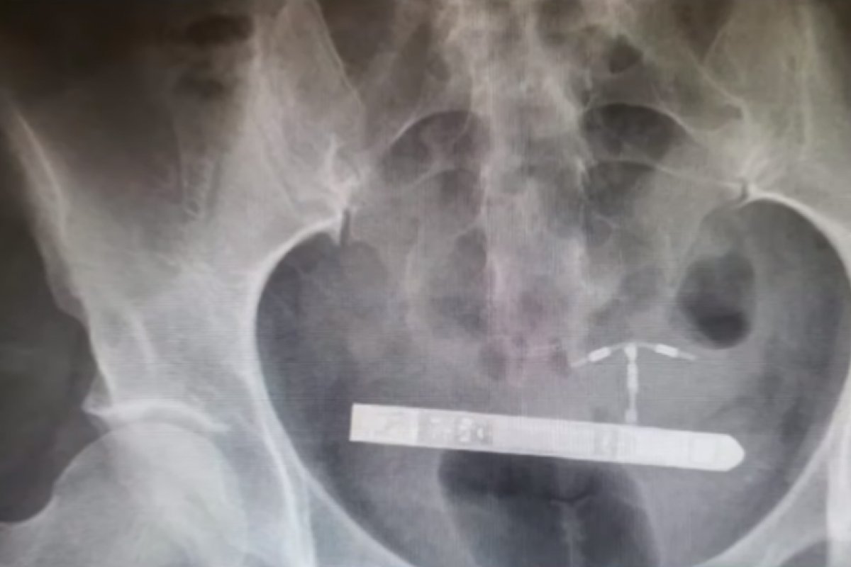 Mulher realiza cirurgia após ficar com vibrador dentro da bexiga