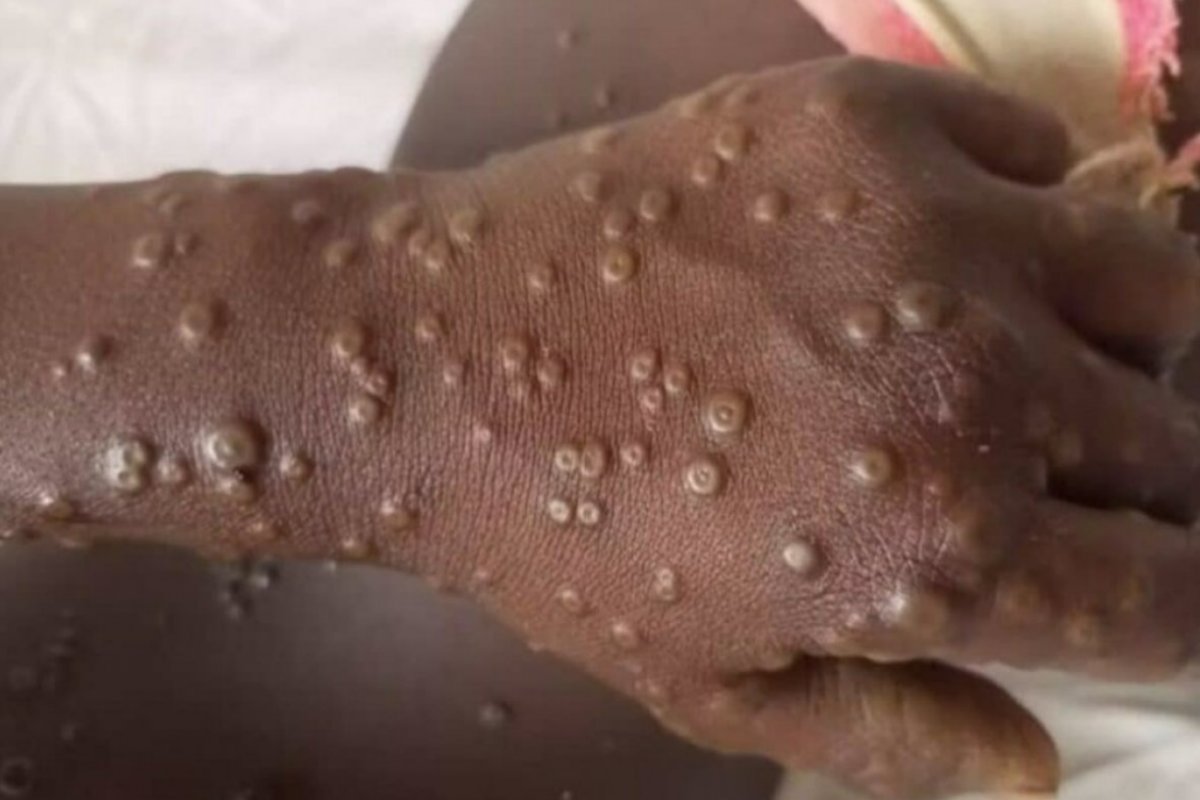 Mundo ultrapassa 100 mil casos de Mpox desde 2022, diz OMS