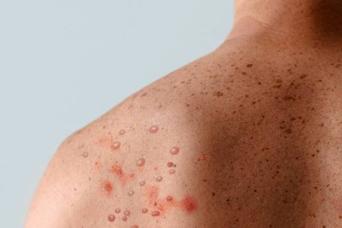 Fim do surto de Mpox é previsto pela ONU com recursos e combate ao estigma