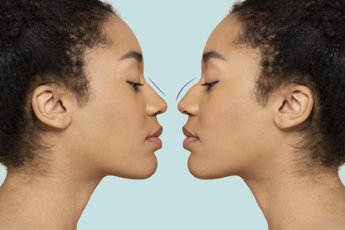 A evolução da rinoplastia: entenda quais os tipos mais comuns!