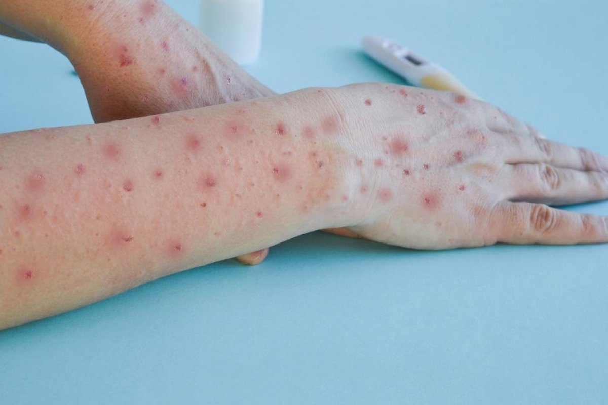 OMS decide que mpox ainda figura como emergência global
