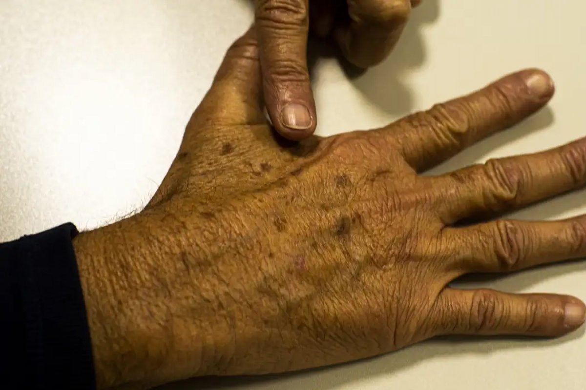 Câncer de pele causa R$ 4,6 mi em gastos hospitalares no período de aproximadamente 2 anos
