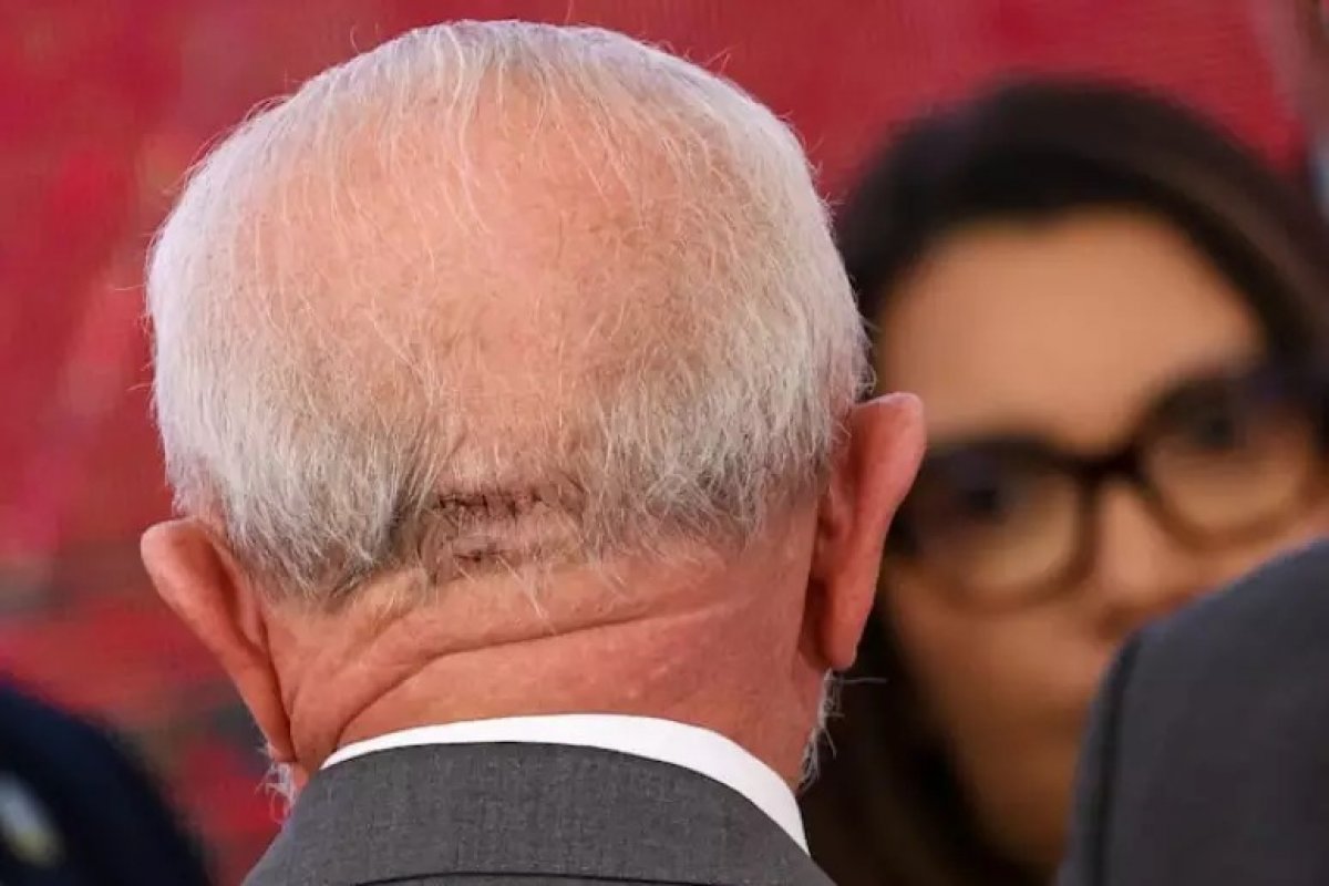 Lula tem hemorragia cerebral e faz cirurgia de emergência em SP