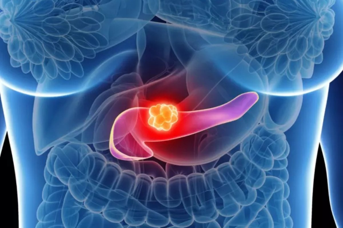Ausência de sintomas dificulta diagnóstico precoce do câncer de pâncreas