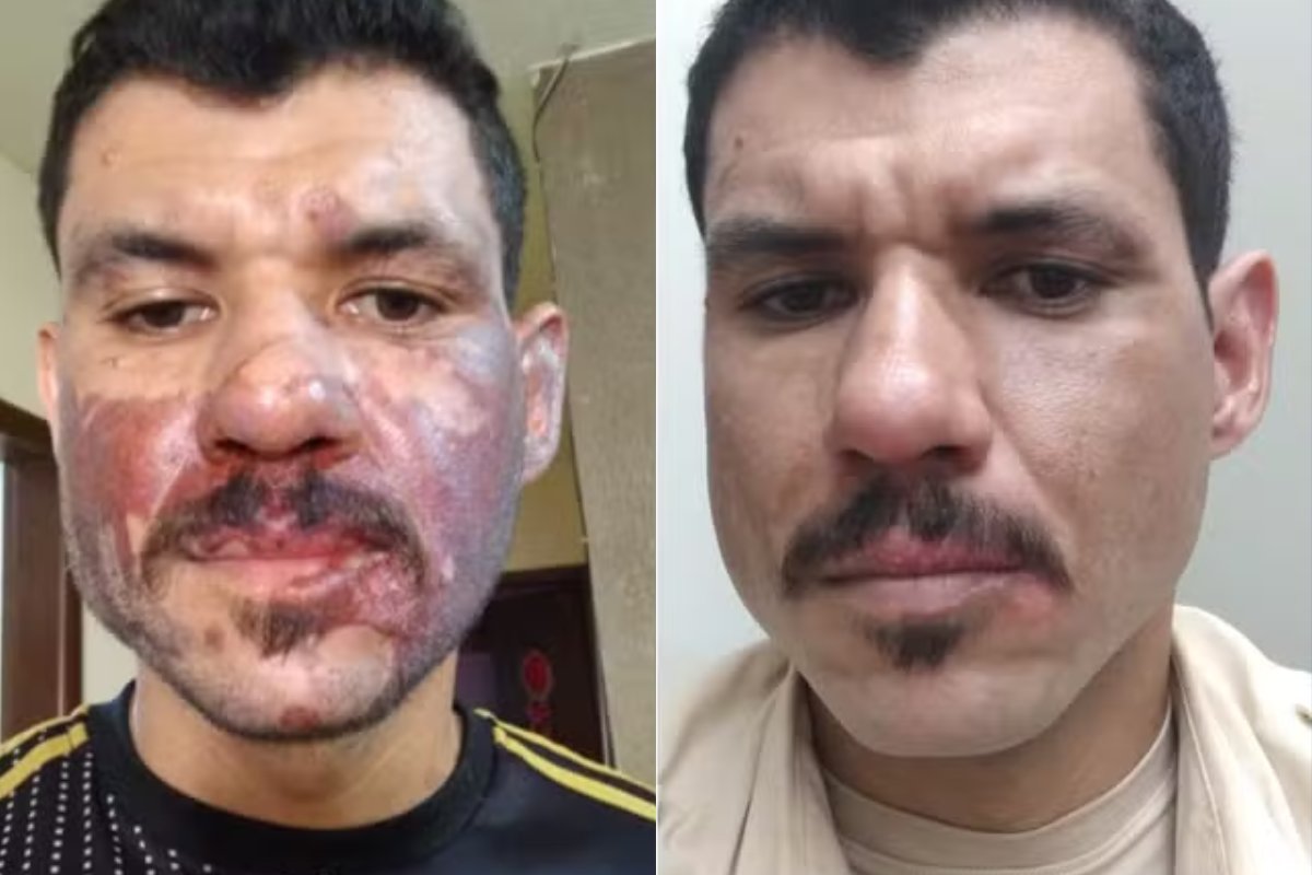 Homem tem queimaduras no rosto após coxinha explodir; salgado havia sido tirado de panela com óleo quente momentos antes