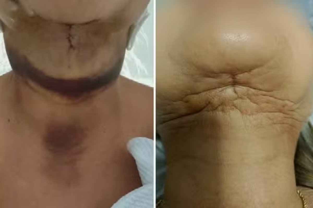 Suspeitos de causar lesões em pacientes, clínica de influenciadores suspeito cobrava até seis vezes menos que o valor de mercado