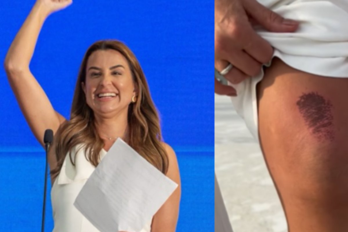 Prefeita de Balneário Camboriú é atropelada por patinete elétrico um dia antes da posse