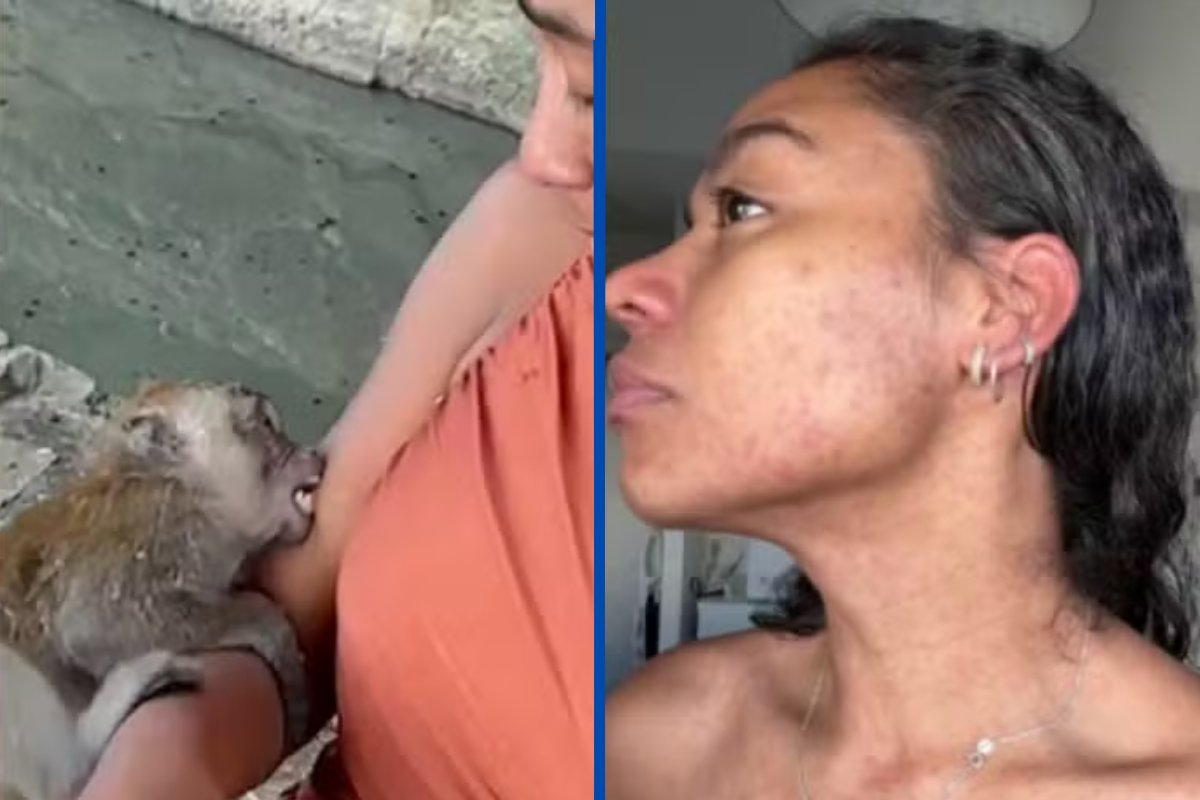 Influenciadora digital baiana é mordida por macaco na Tailândia e apresenta reação alérgica à vacina de tratamento contra a raiva