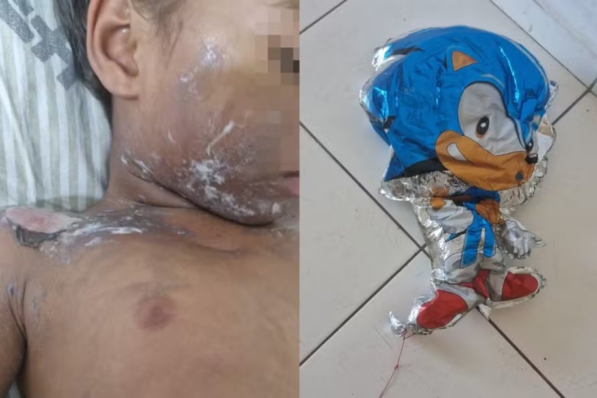 Criança de 3 anos sofre queimaduras no rosto e corpo após balão de gás estourar em Porto Seguro