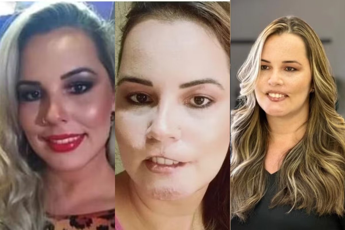 Influencer que perdeu o lábio por uso de PMMA, compartilha resultado após reconstrução