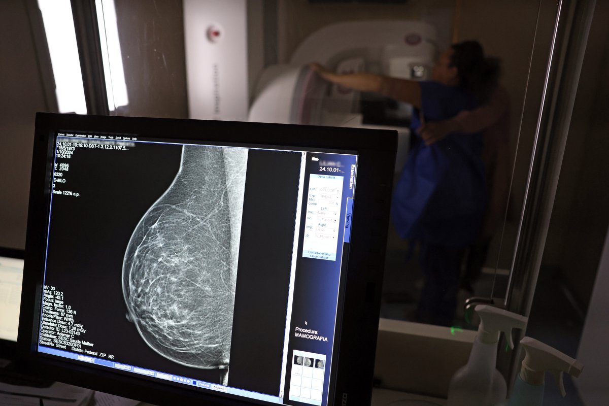 Conselho de Medicina pede à ANS que revogue recomendação de mamografia só a partir de 50 anos