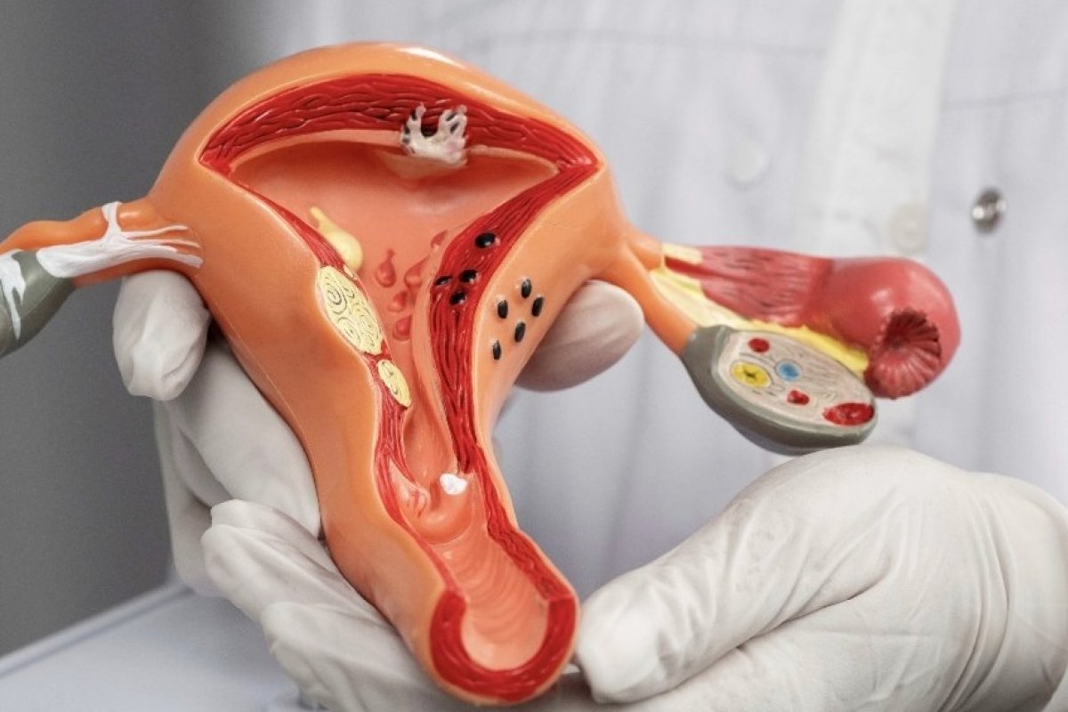 No mês da visibilidade para a endometriose especialista fala sobre avanços médicos no tratamento da doença!