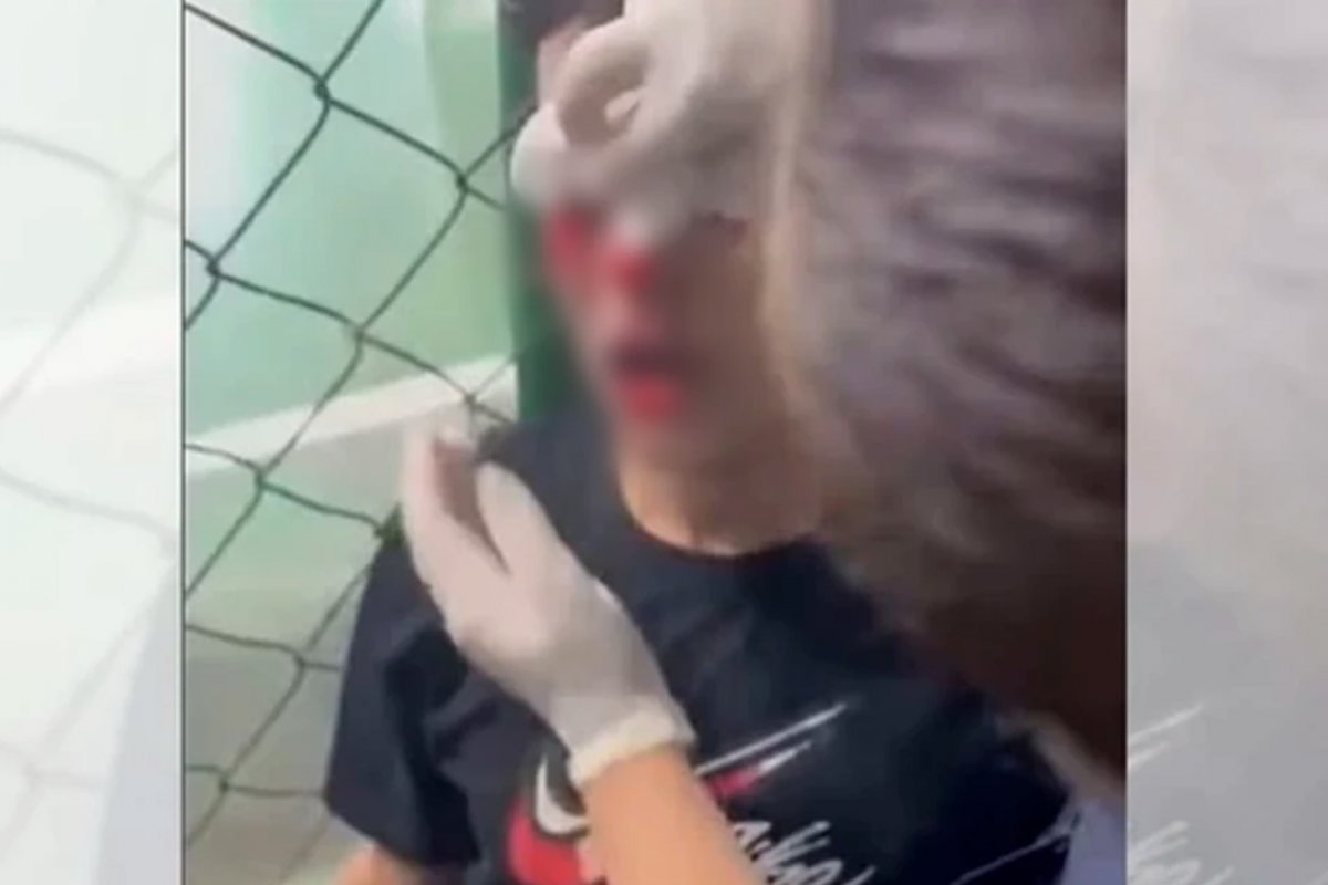 Jogador de futsal fica gravemente ferido após bomba explodir em vestiário