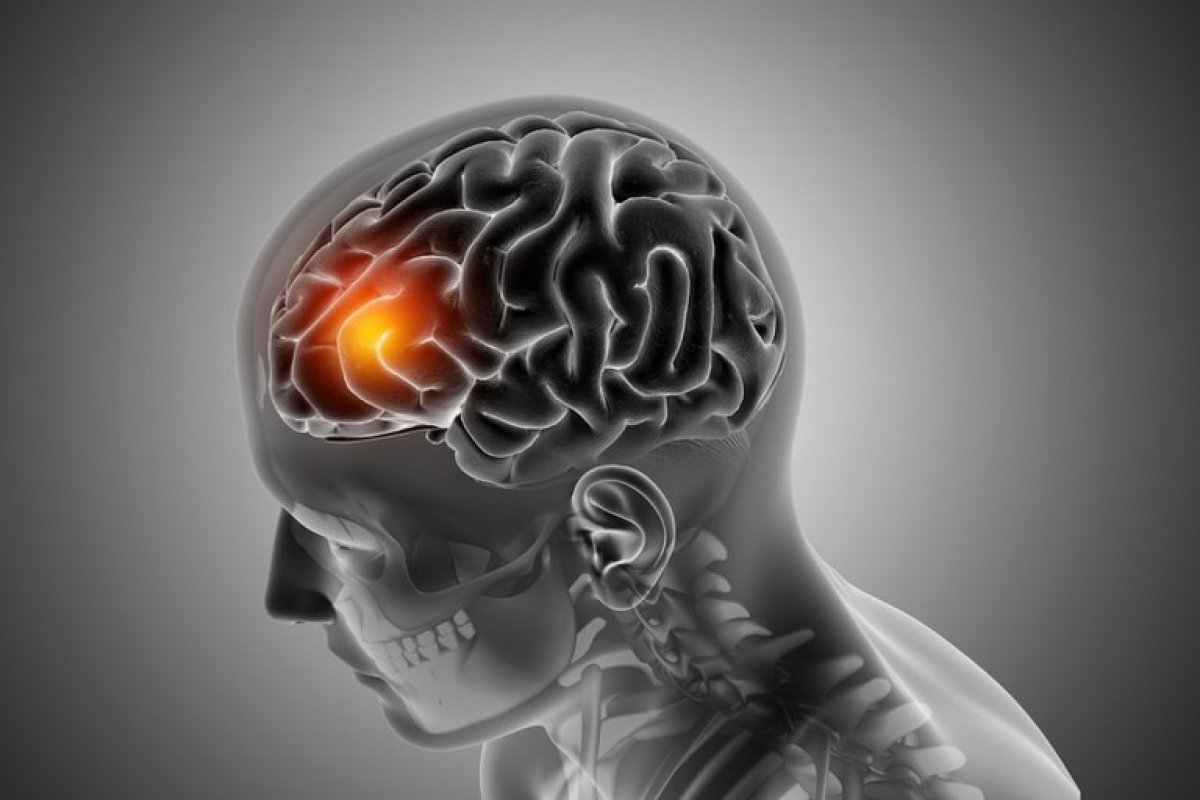 AVC, principal causa de morte cardíaca no Brasil, tem deficiência em prevenção e em atendimento rápido no SUS