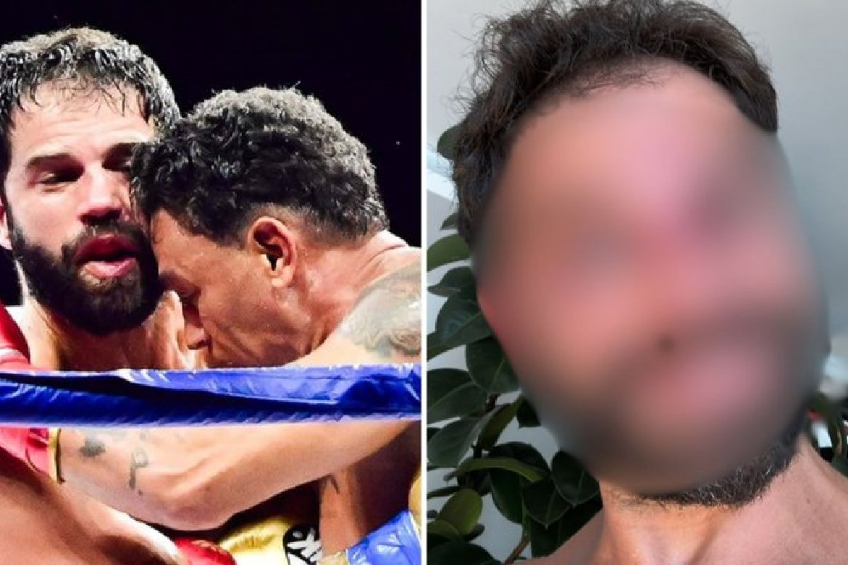 Duda Nagle surge com o rosto 'desconfigurado' após luta com Popó!