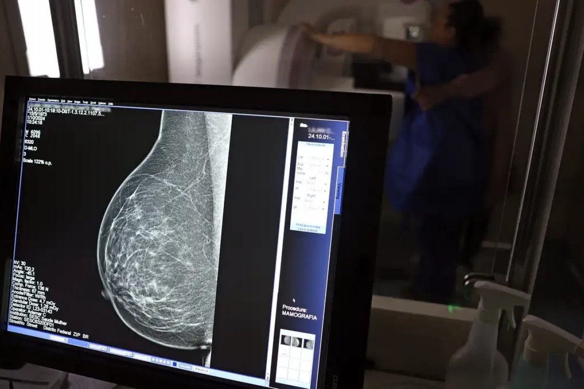 Uma em cada três pacientes com câncer de mama no Brasil tem menos de 50 anos, aponta estudo