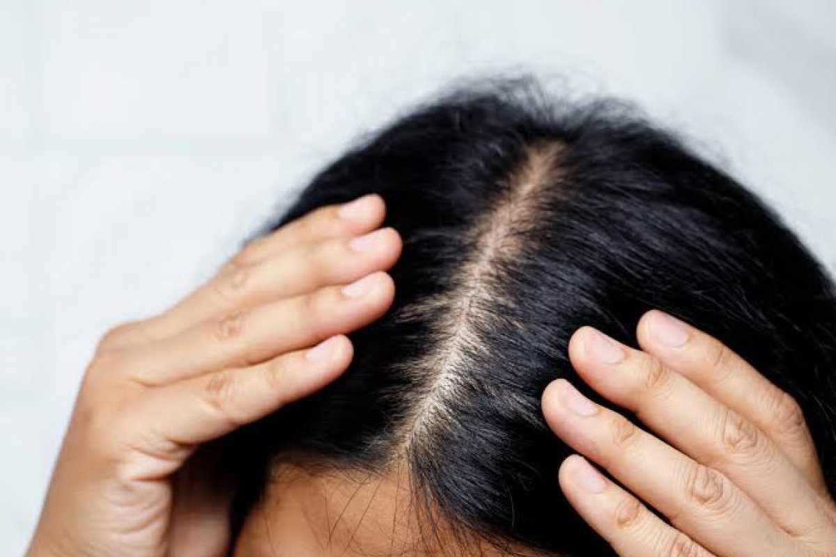 Alopecia feminina: causas, diagnóstico e os tratamentos mais eficazes! 