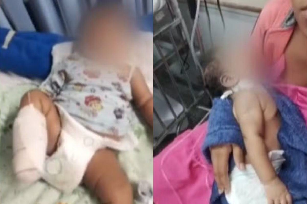 Bebê de 2 meses tem pé amputado após infecção na Bahia; família acusa hospital de negligência