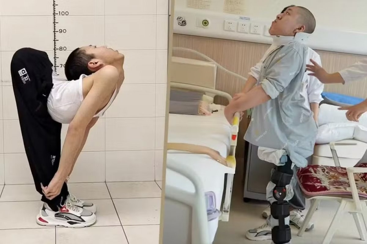 Após cirurgias na coluna, jovem chinês consegue ficar em pé e deitar pela 1ª vez