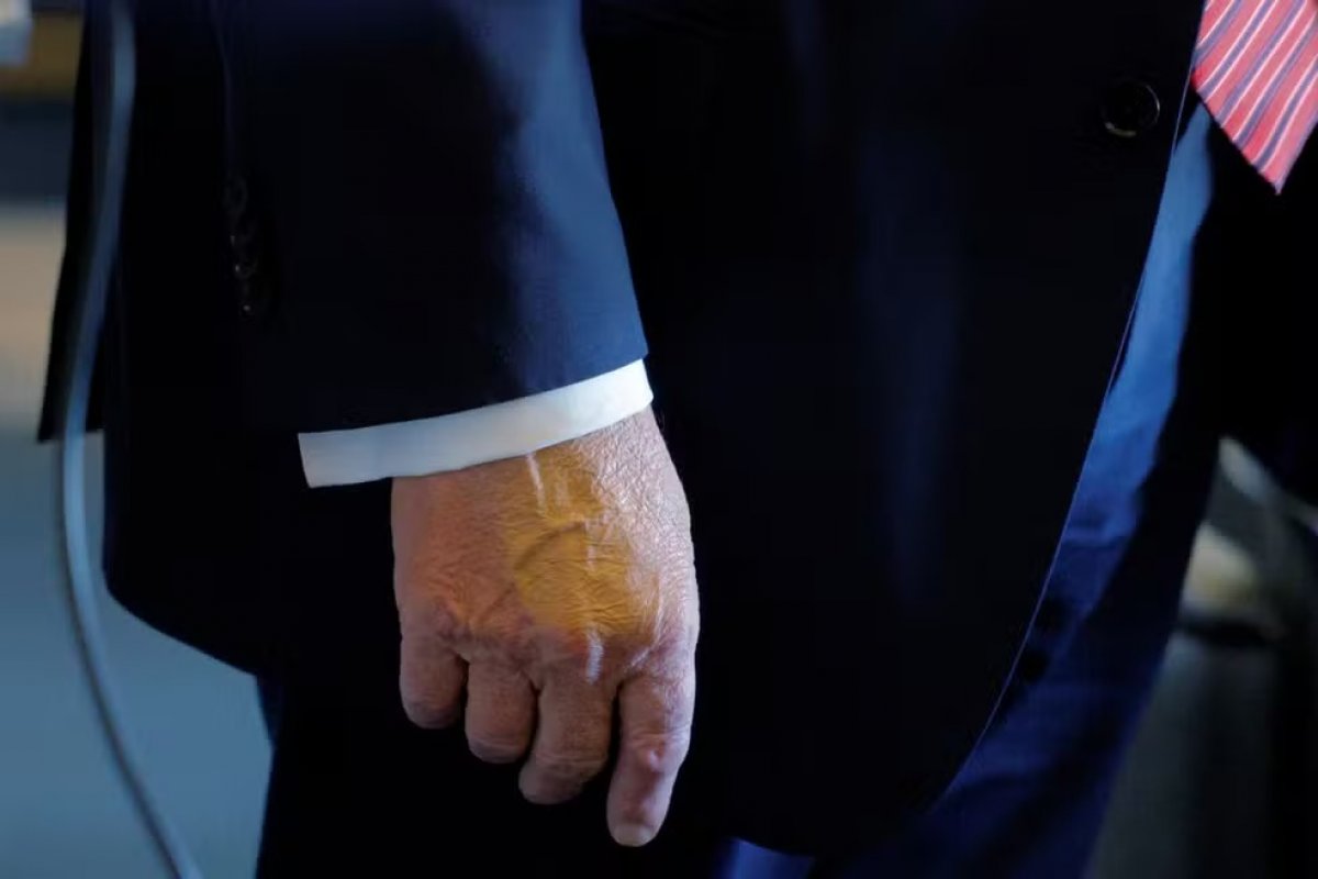 Presidente Trump foi flagrado com mão maquiada e pés inchados antes de diagnóstico de insuficiência venosa crônica