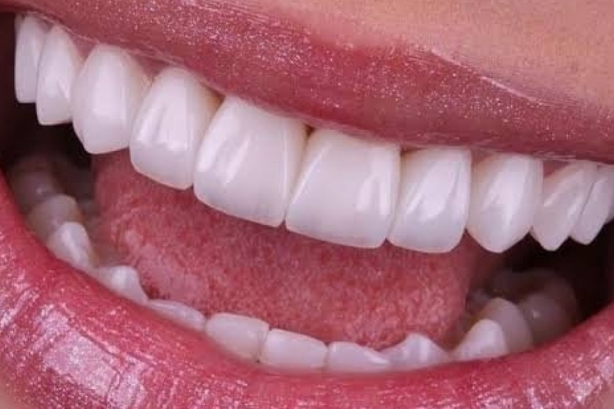 Saiba quais hábitos podem danificar suas lentes de contato dentárias! 