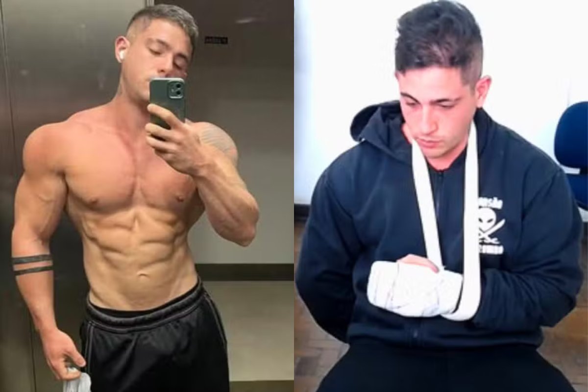 MP denuncia fisiculturista que espancou e quebrou ossos do rosto de namorada; vítima passará por nova cirurgia na face