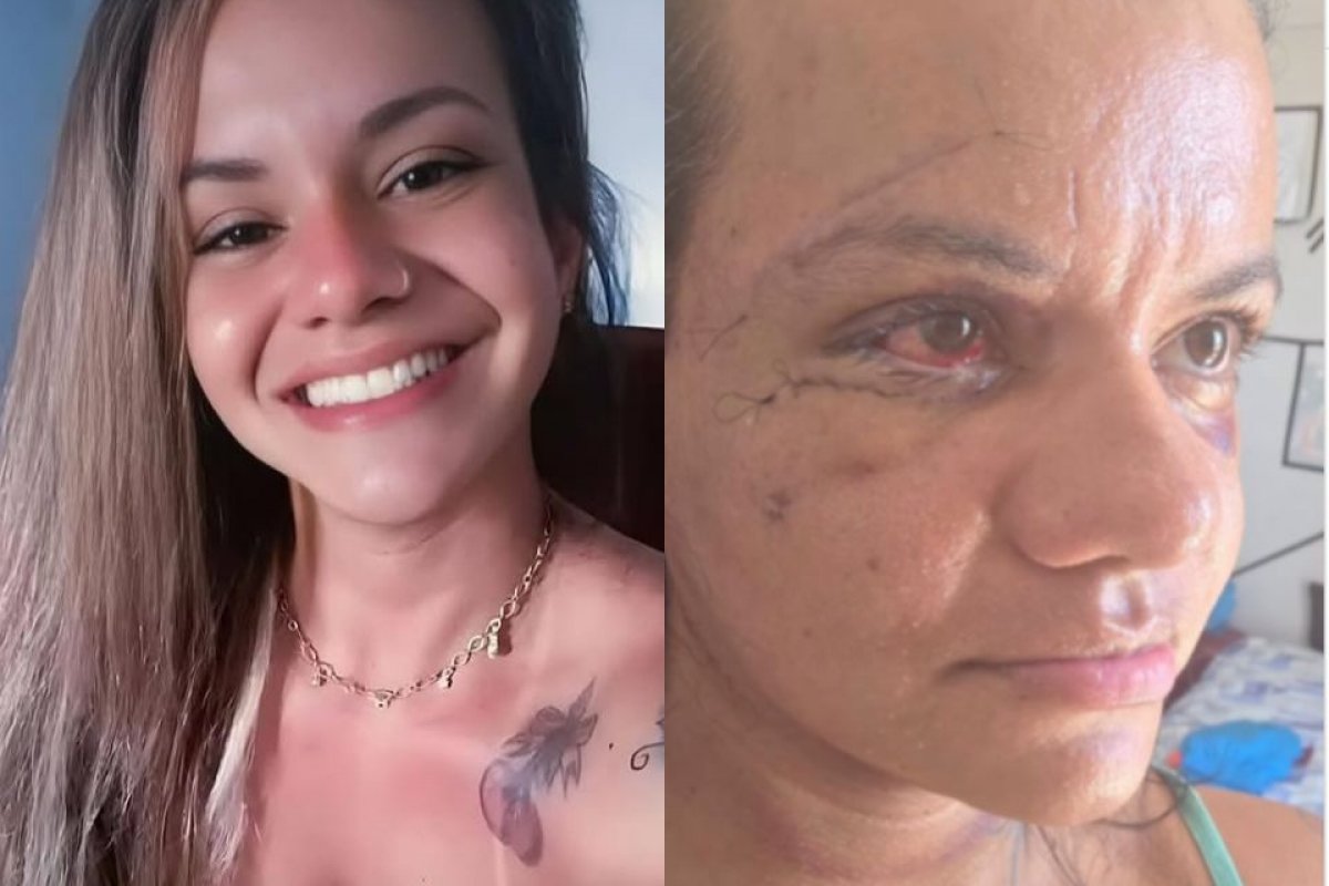 Mulher agredida com mais de 60 socos divulga foto sete dias após cirurgia para reconstrução da face