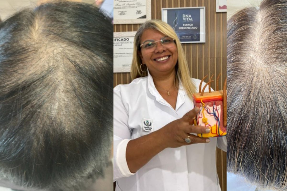 Queda, oleosidade e calvície: saiba como a terapia capilar pode tratar a saúde do couro cabeludo e promover qualidade de vida