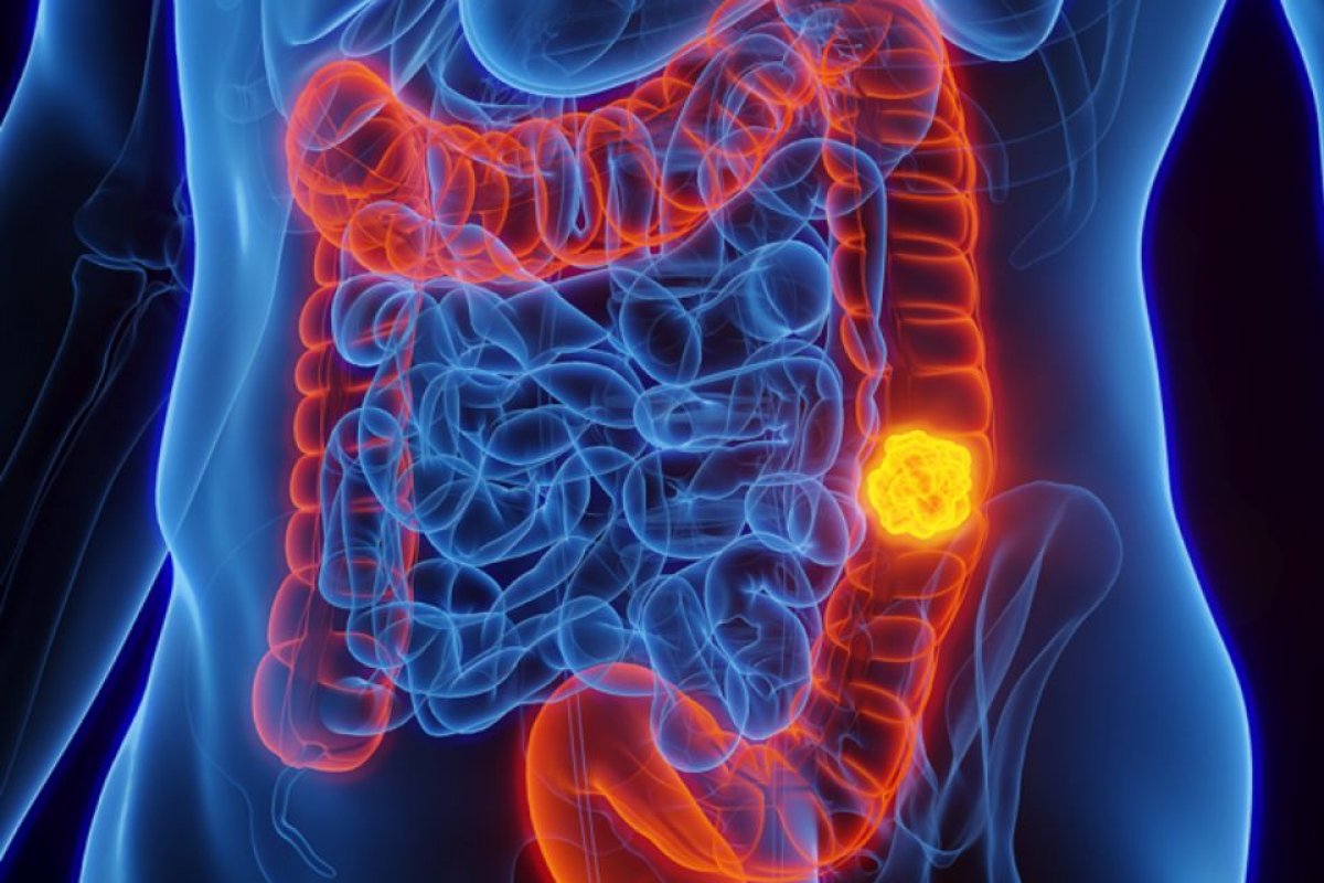 Câncer colorretal é mais agressivo entre os jovens, diz estudo brasileiro