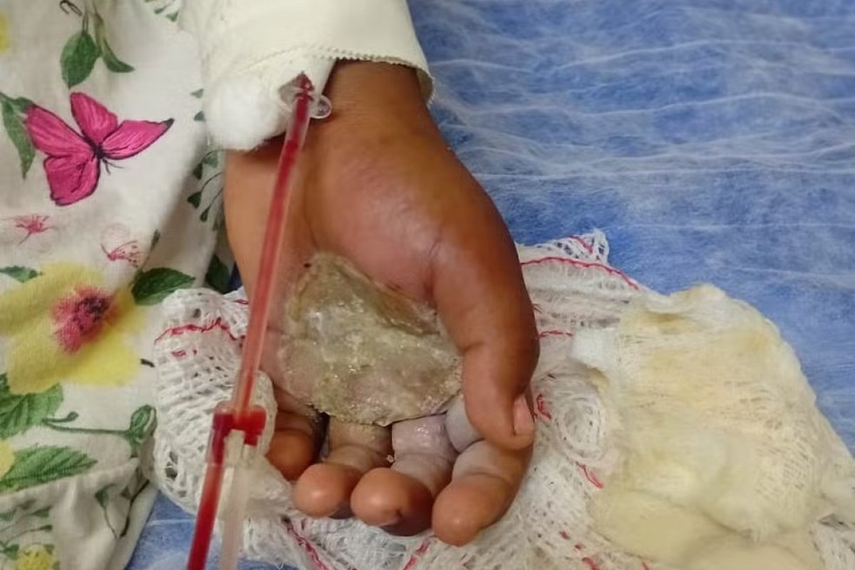 Polícia prende mãe por torturar a filha com ovo quente no Rio 