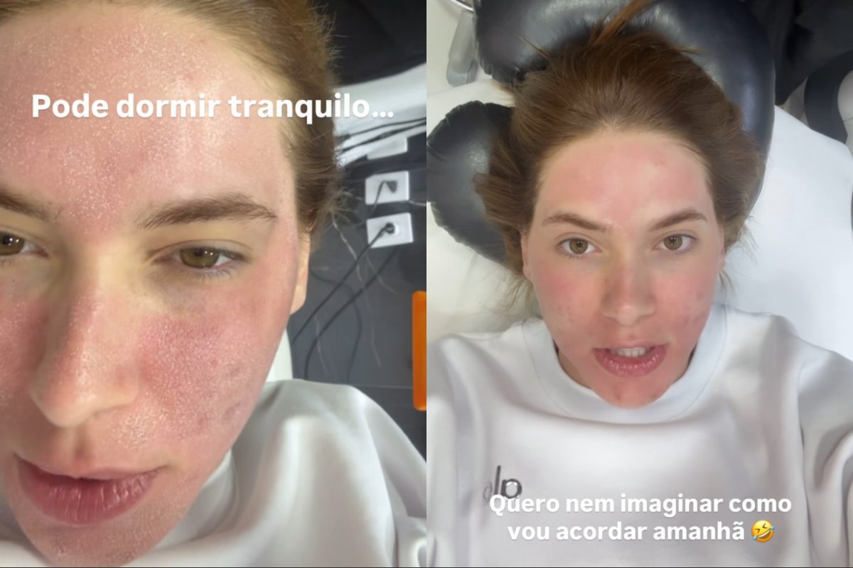Virginia mostra procedimento com laser no rosto e médica explica como funcionam as diferentes tecnologias! 
