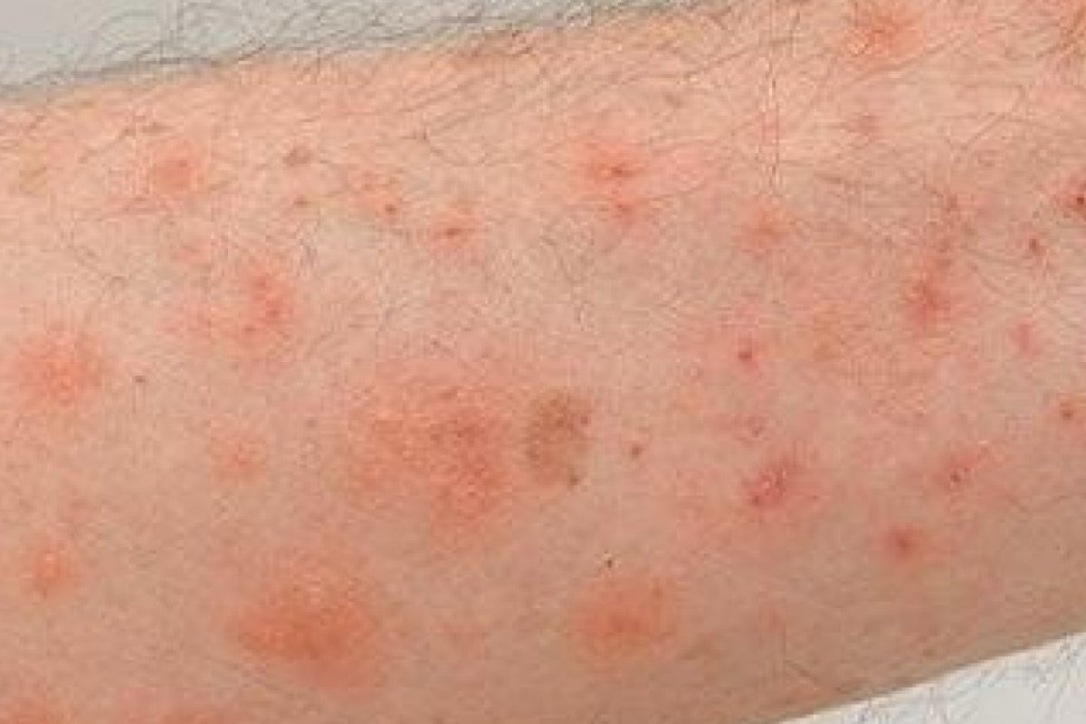 Surto de escabiose é registrado em cidade no interior da Bahia