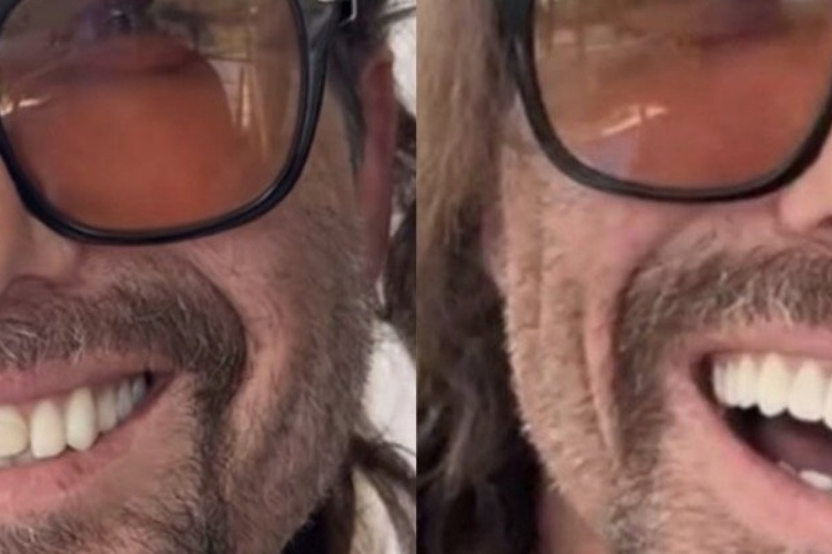 Hudson, da dupla Edson & Hudson, surpreende fãs ao mostrar que lente dental caiu!