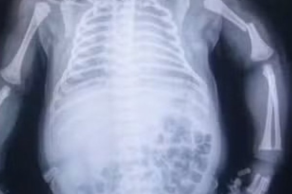 [Família denuncia negligência depois de ter braço quebrado durante parto em Salvador ]