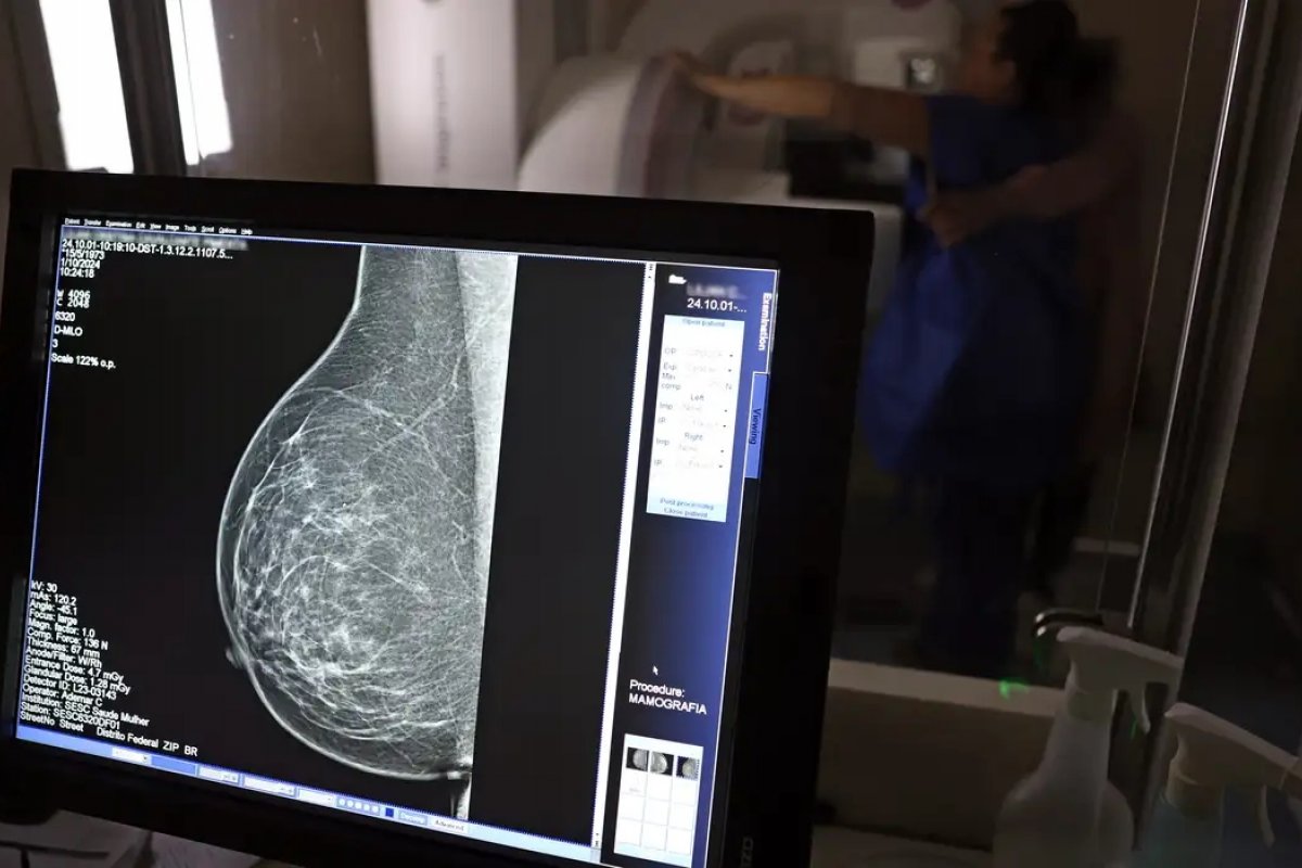 Mamografias pelo SUS alcançam menos de 40% das mulheres de 50 a 69 anos