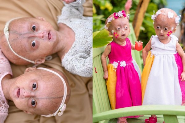 [Progéria: conheça síndrome genética rara que provoca envelhecimento precoce; únicas gêmeas do mundo com condição são brasileiras]