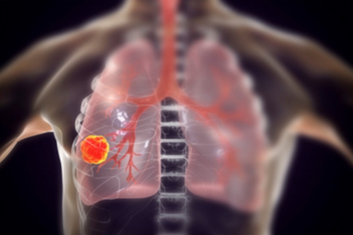 Vacina para prevenir câncer de pulmão inicia testes em humanos; entenda como funciona