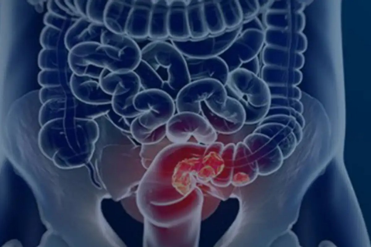 Pacientes com câncer colorretal são diagnosticados em estágio avançado