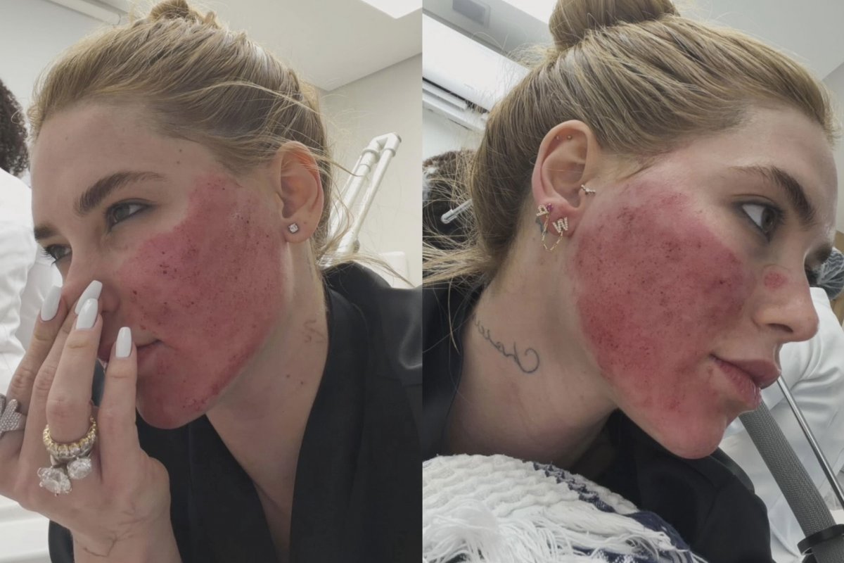 Virginia Fonseca surge com rosto avermelhado após procedimentos estéticos e especialista explica reação!