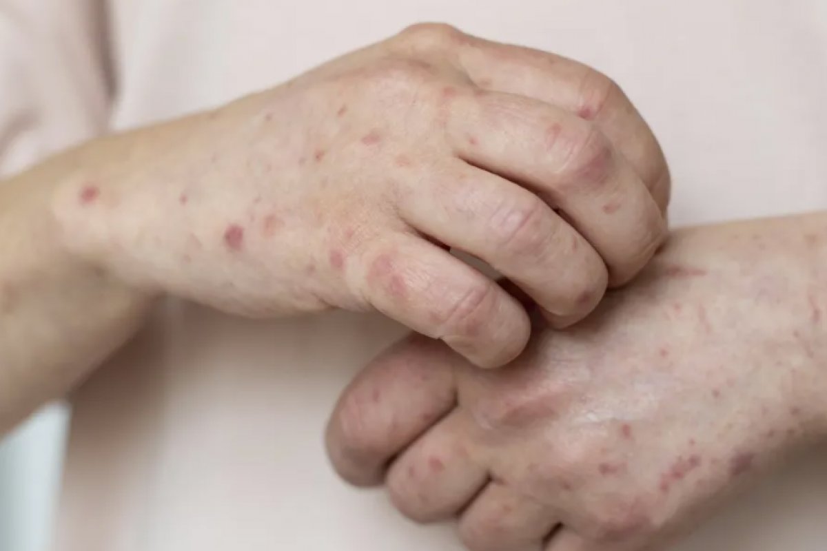 São Paulo registra segundo caso de sarampo em 2025