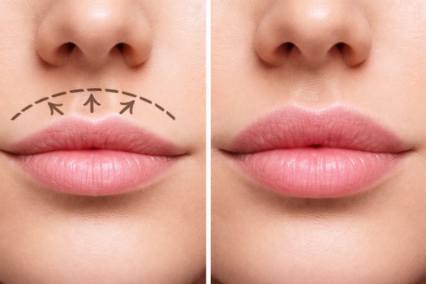 [Cirurgião baiano explica o Lip Lift - técnica que reposiciona o sorriso e transforma sem exageros!   ]