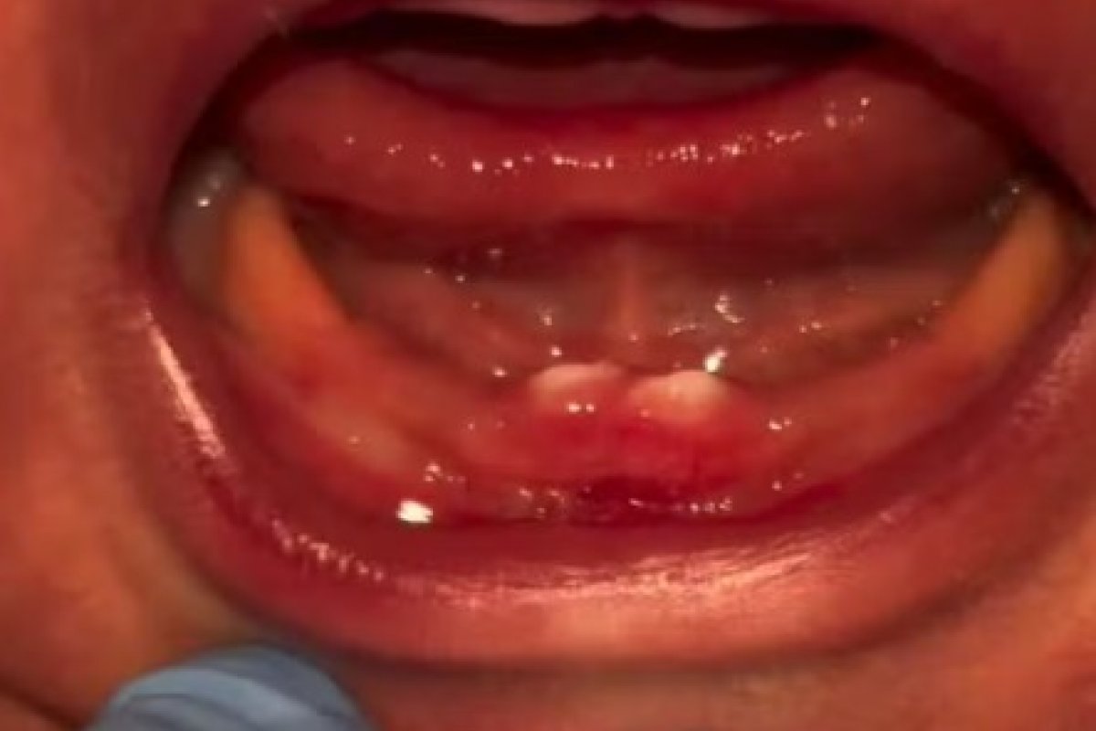 Bebê passa por cirurgia após nascer com dentes em cidade de Rondônia