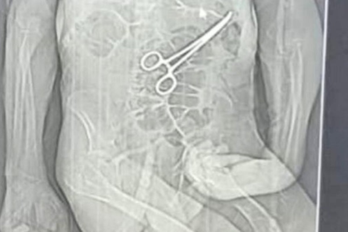 Família acusa hospital de esquecer pinça em corpo de idoso morto na véspera do Natal em MG