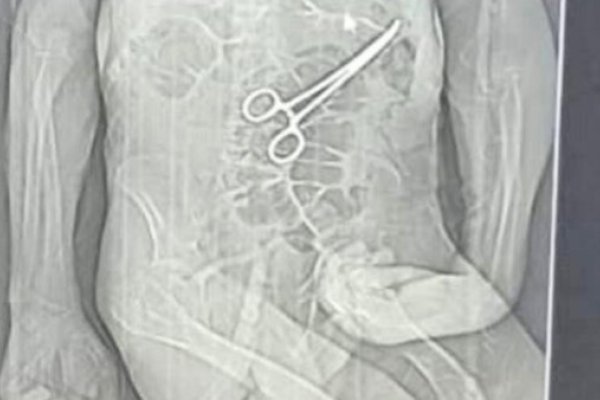 [Família acusa hospital de esquecer pinça em corpo de idoso morto na véspera do Natal em MG]