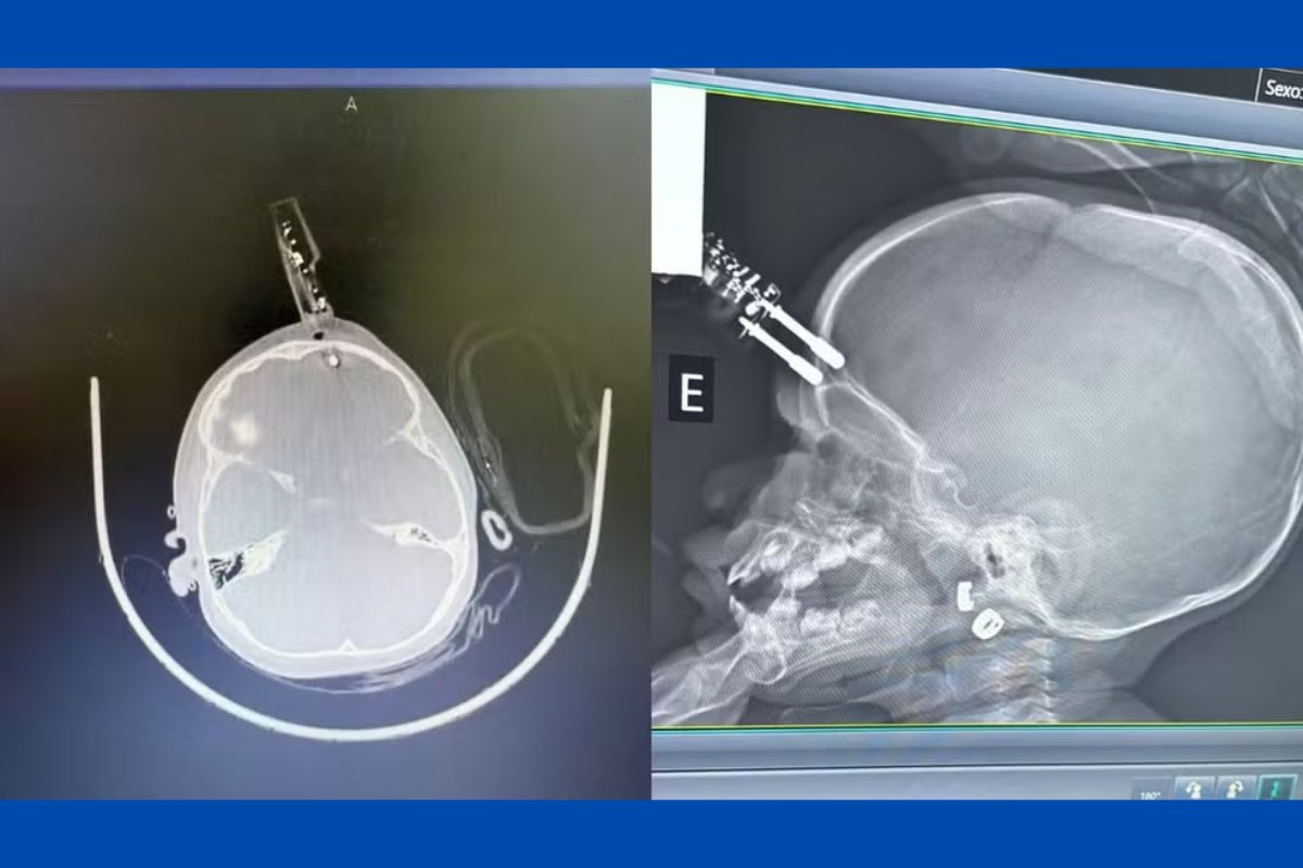 Imagem forte: menina de 1 ano cai de cama e fica com carregador cravado na testa em Minas Gerais