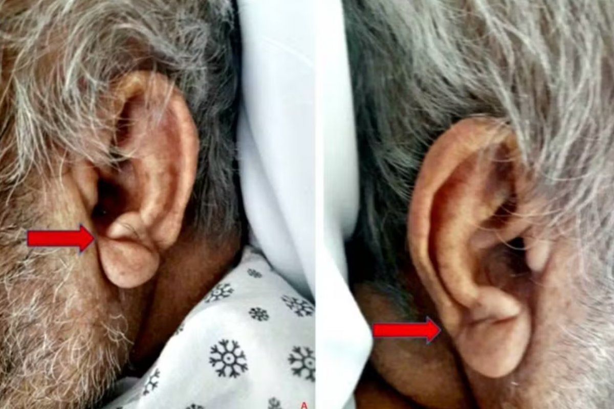 Dobra no lóbulo da orelha pode estar associada a risco cardiovascular, apontam estudos