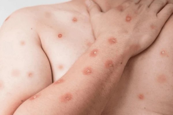 [Brasil registra 88 casos confirmados de mpox em 2026; São Paulo concentra a maioria dos registros]