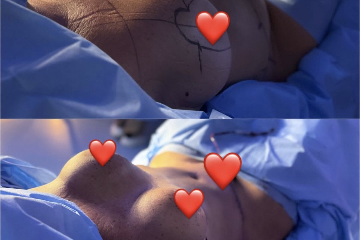 Mãe de Virgínia, Margareth Serrão passa por abdominoplastia e coloca silicone; especialista explica procedimentos e cuidados! 