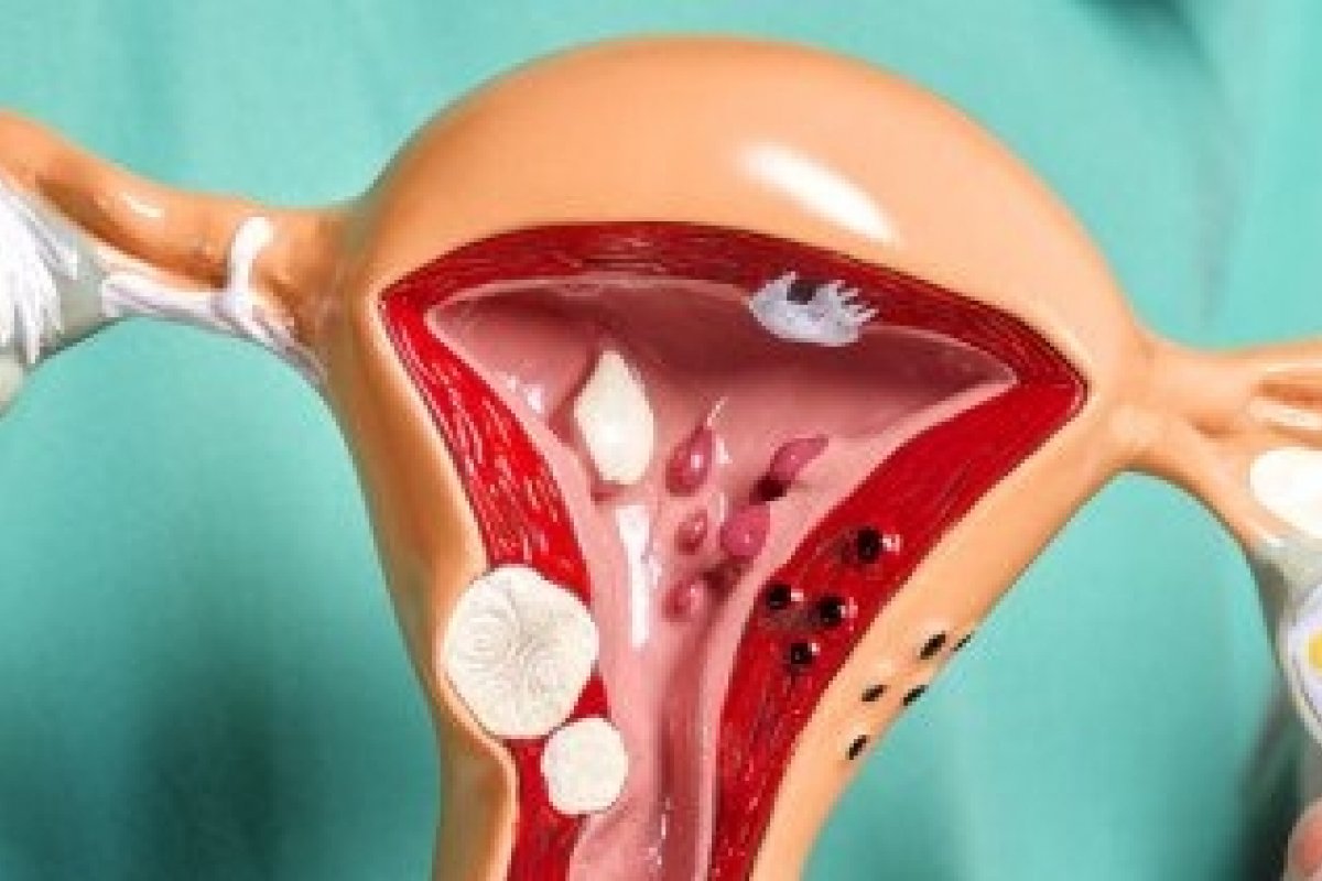 Robótica amplia precisão no tratamento da endometriose! 